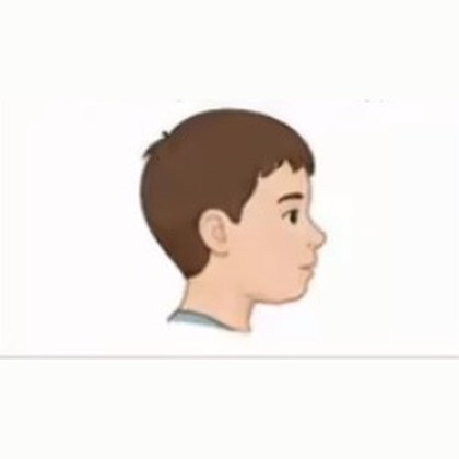 Congenital Abnormality — score 3: Severe